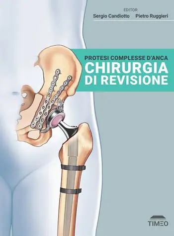 Offerta Lampo Protesi complesse d‘anca. Chirurgia di revisione. Ediz. illustrata